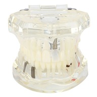 Transparentná choroba Laboratórny model zubov